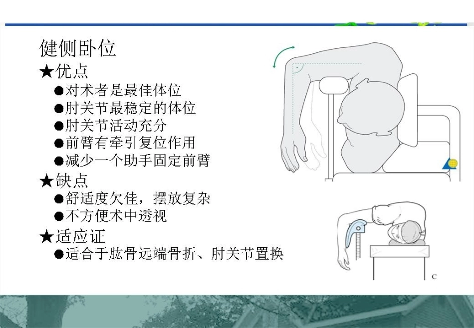 肱骨远端C型骨折的手术入路_第14页