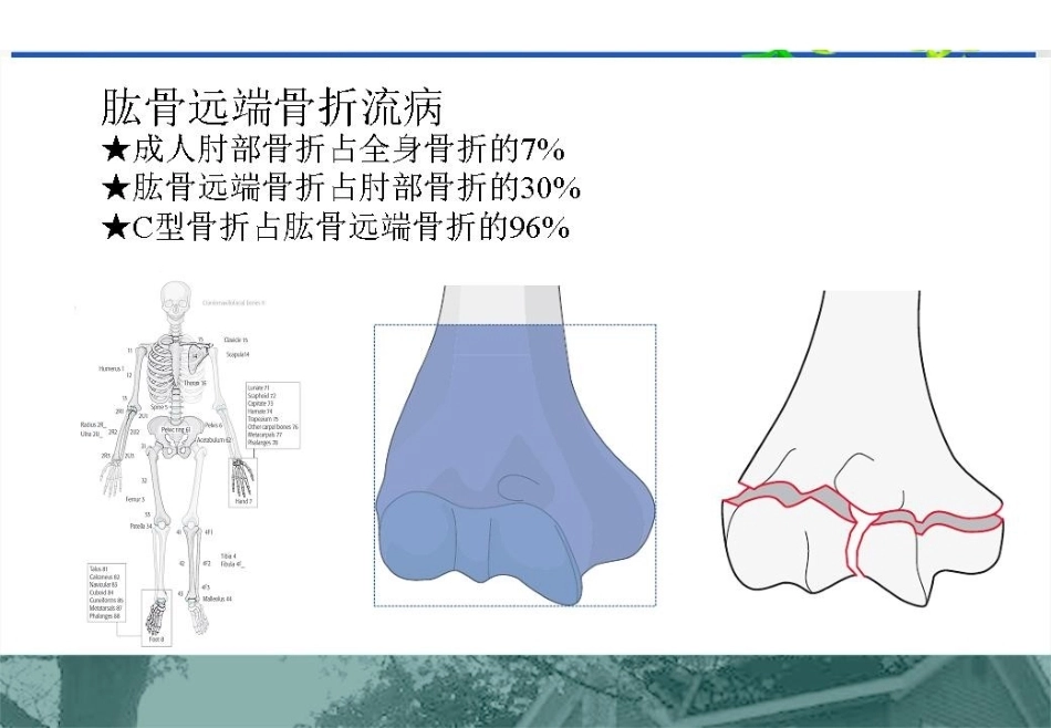 肱骨远端C型骨折的手术入路_第3页