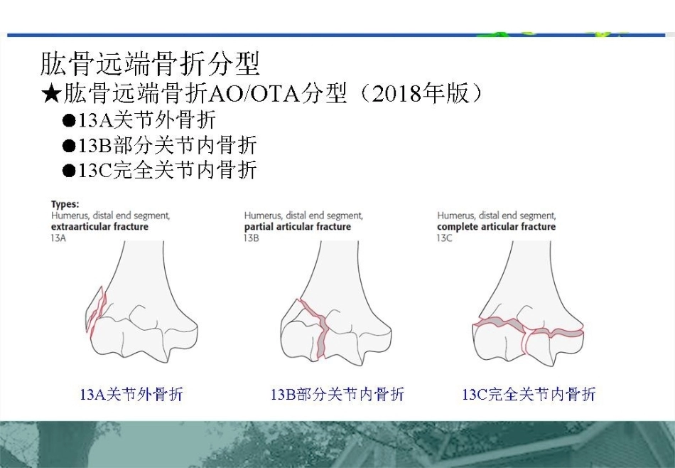 肱骨远端C型骨折的手术入路_第4页