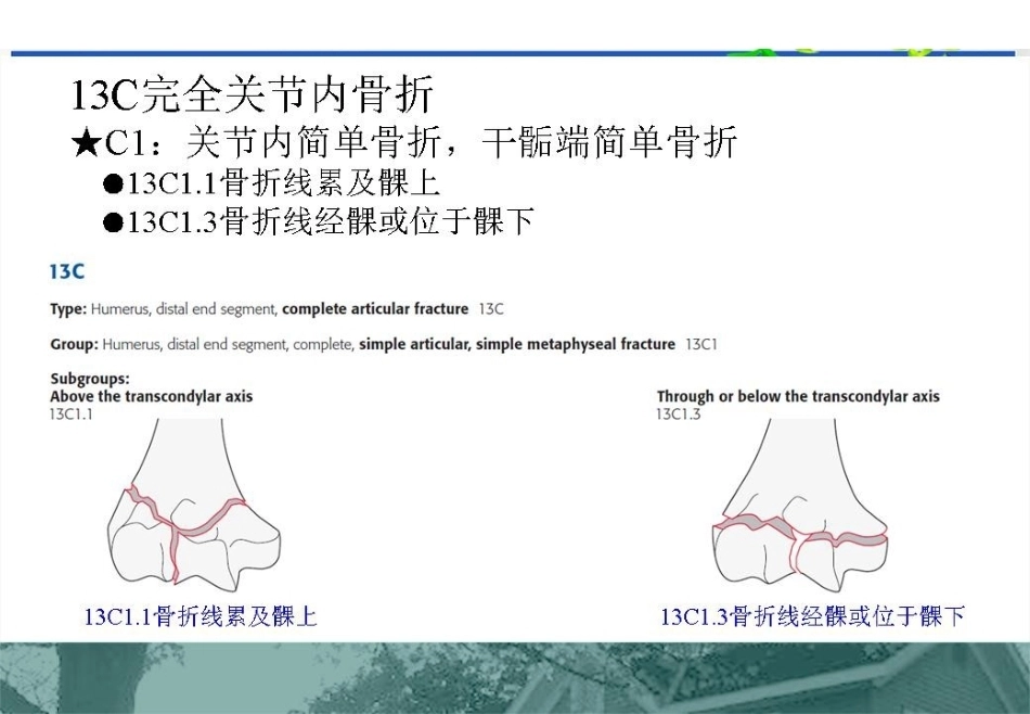 肱骨远端C型骨折的手术入路_第5页
