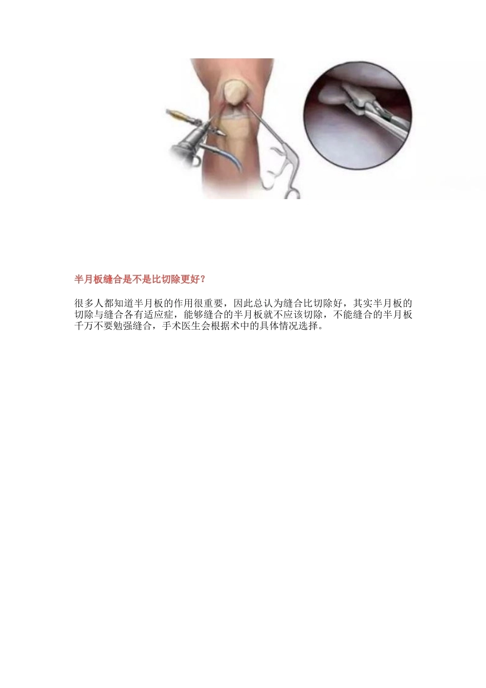 半月板损伤的治 疗技巧_第11页
