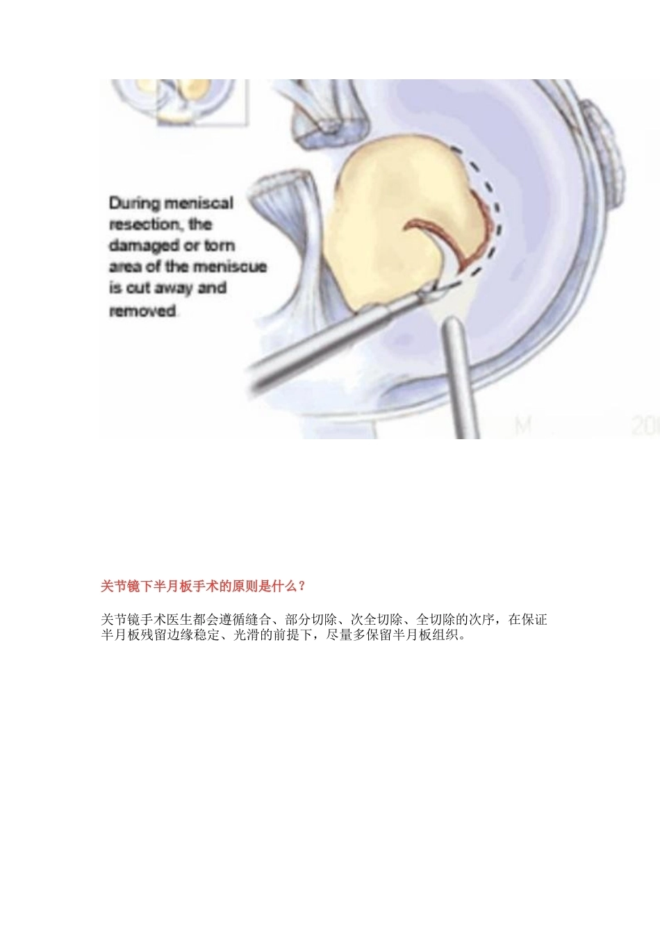 半月板损伤的治 疗技巧_第12页