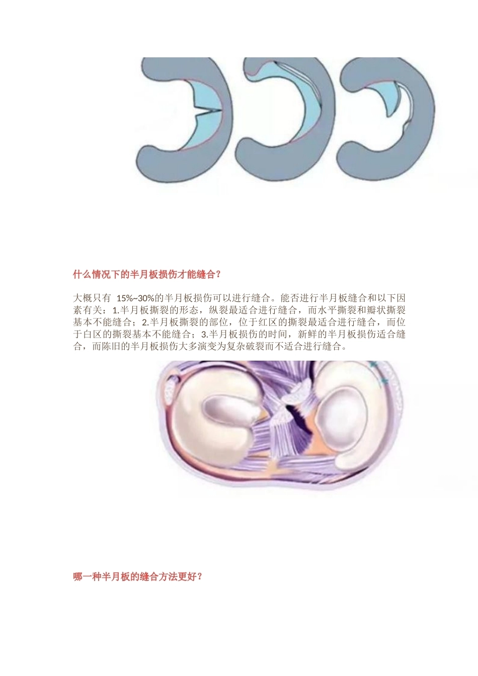 半月板损伤的治 疗技巧_第14页