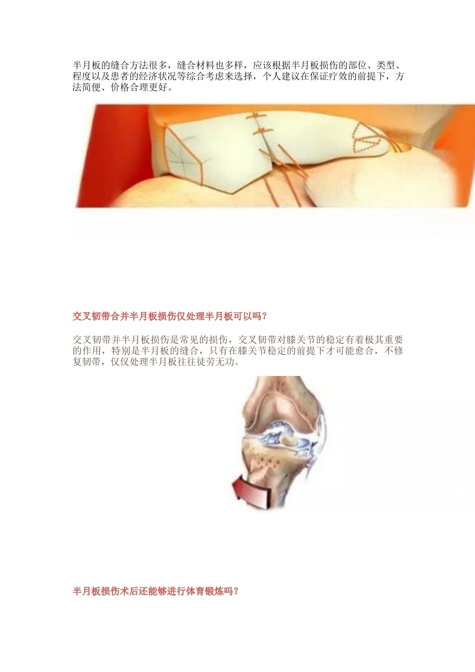 半月板损伤的治 疗技巧_第15页