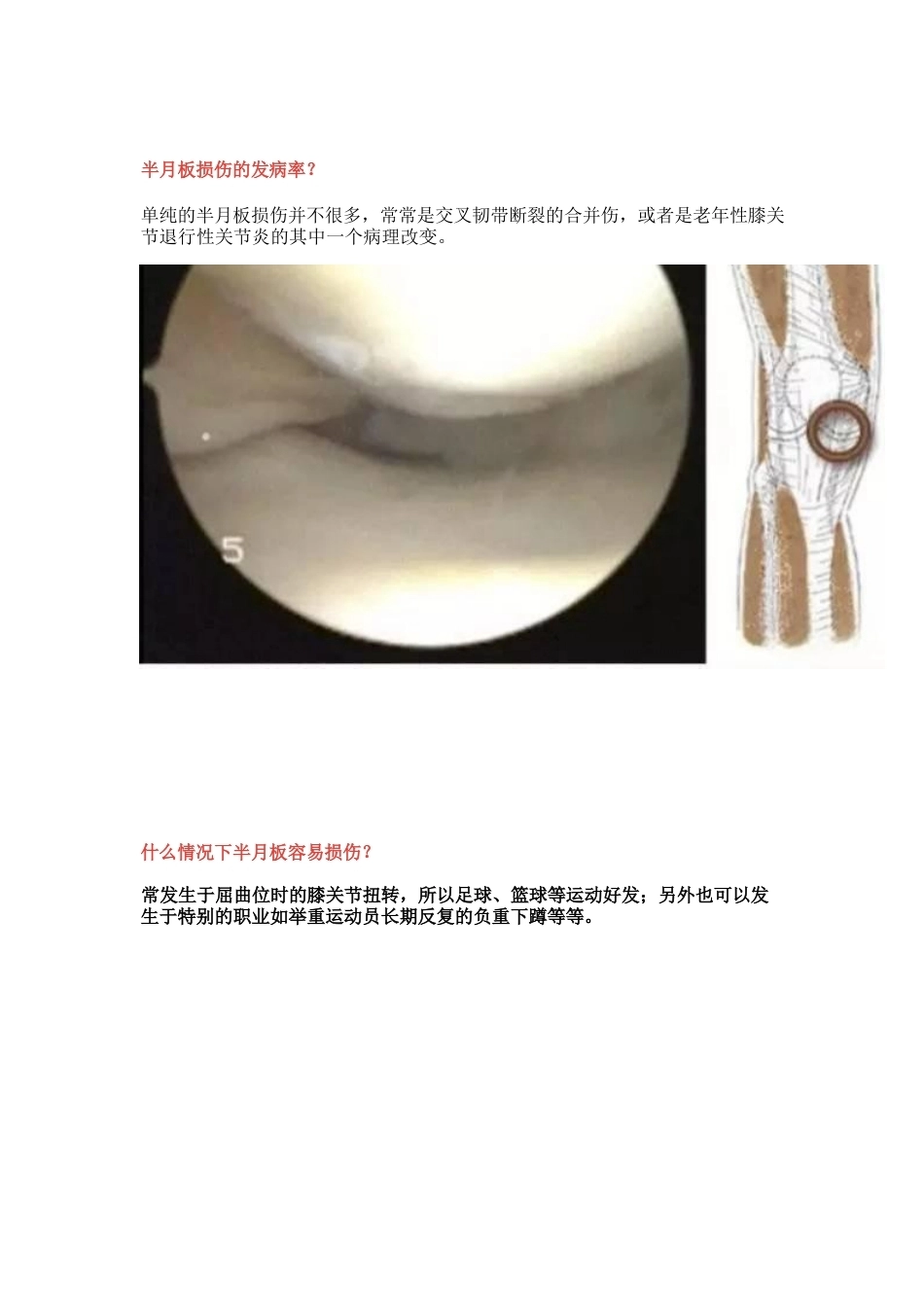 半月板损伤的治 疗技巧_第2页