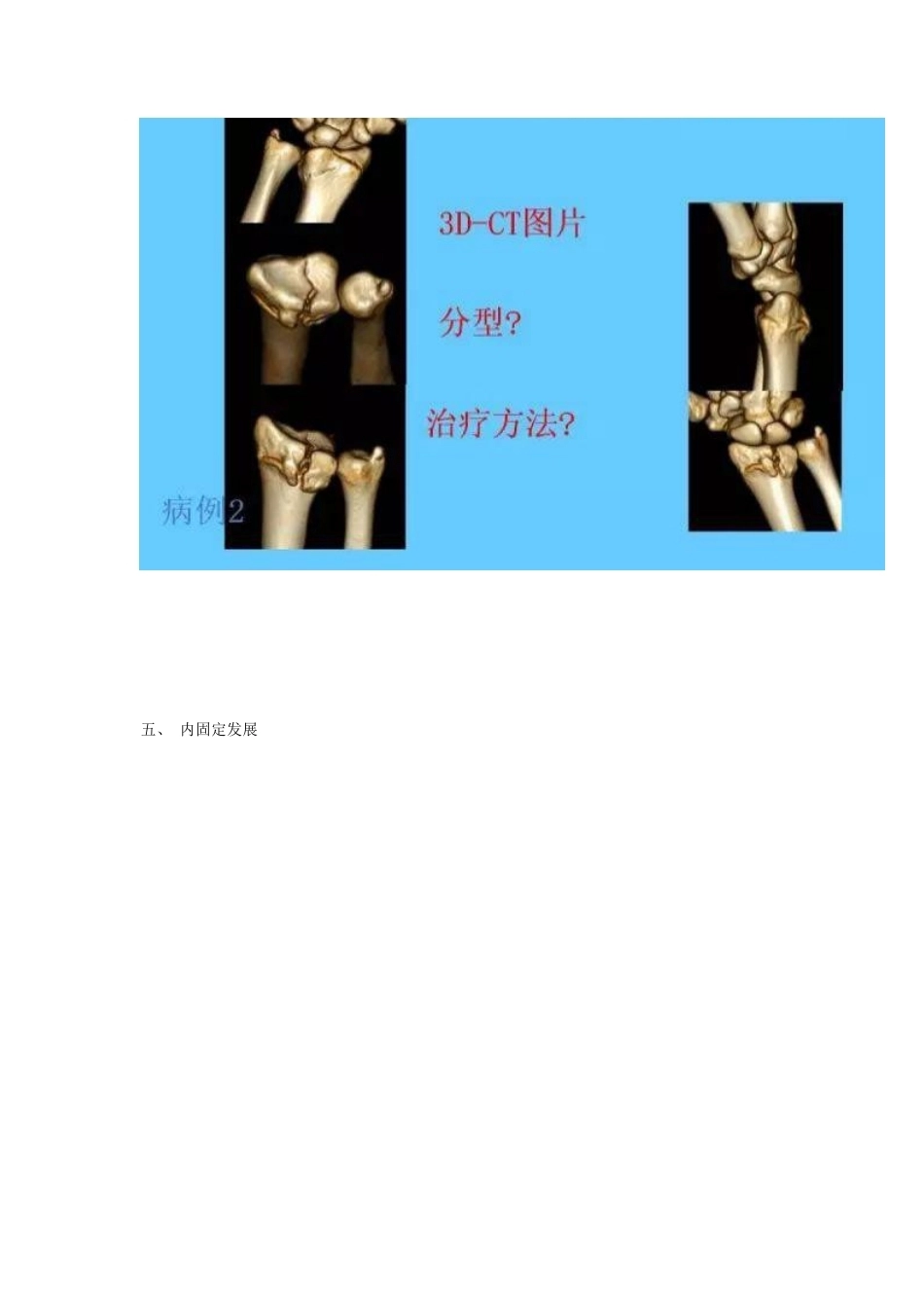 桡骨远端骨折 的治疗策略_第11页