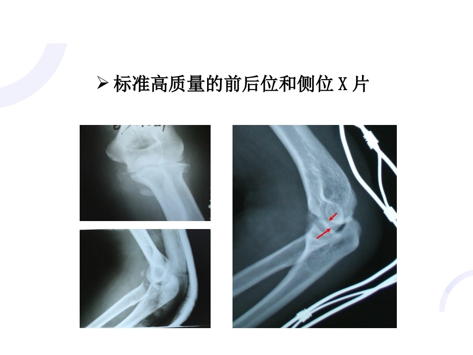 肘关节“恐怖三 联征“_第10页