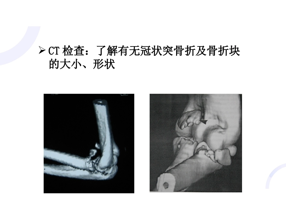 肘关节“恐怖三 联征“_第11页
