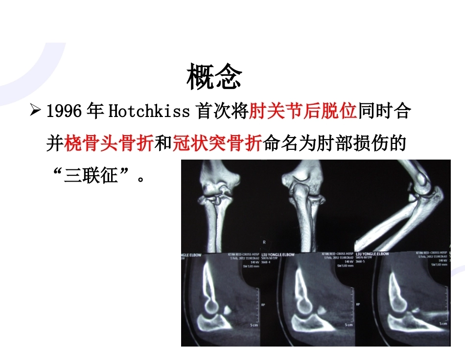 肘关节“恐怖三 联征“_第2页
