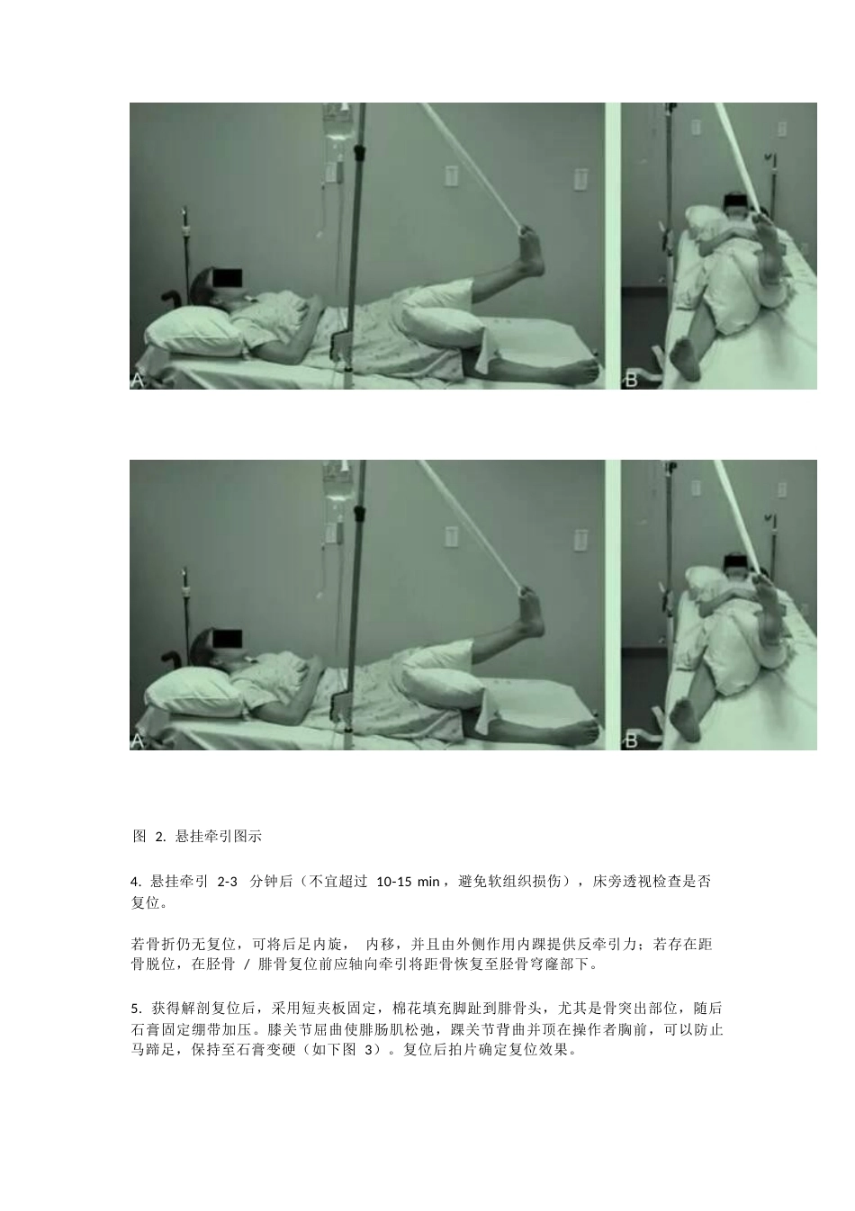 踝关节骨折闭合 复位技巧_第2页
