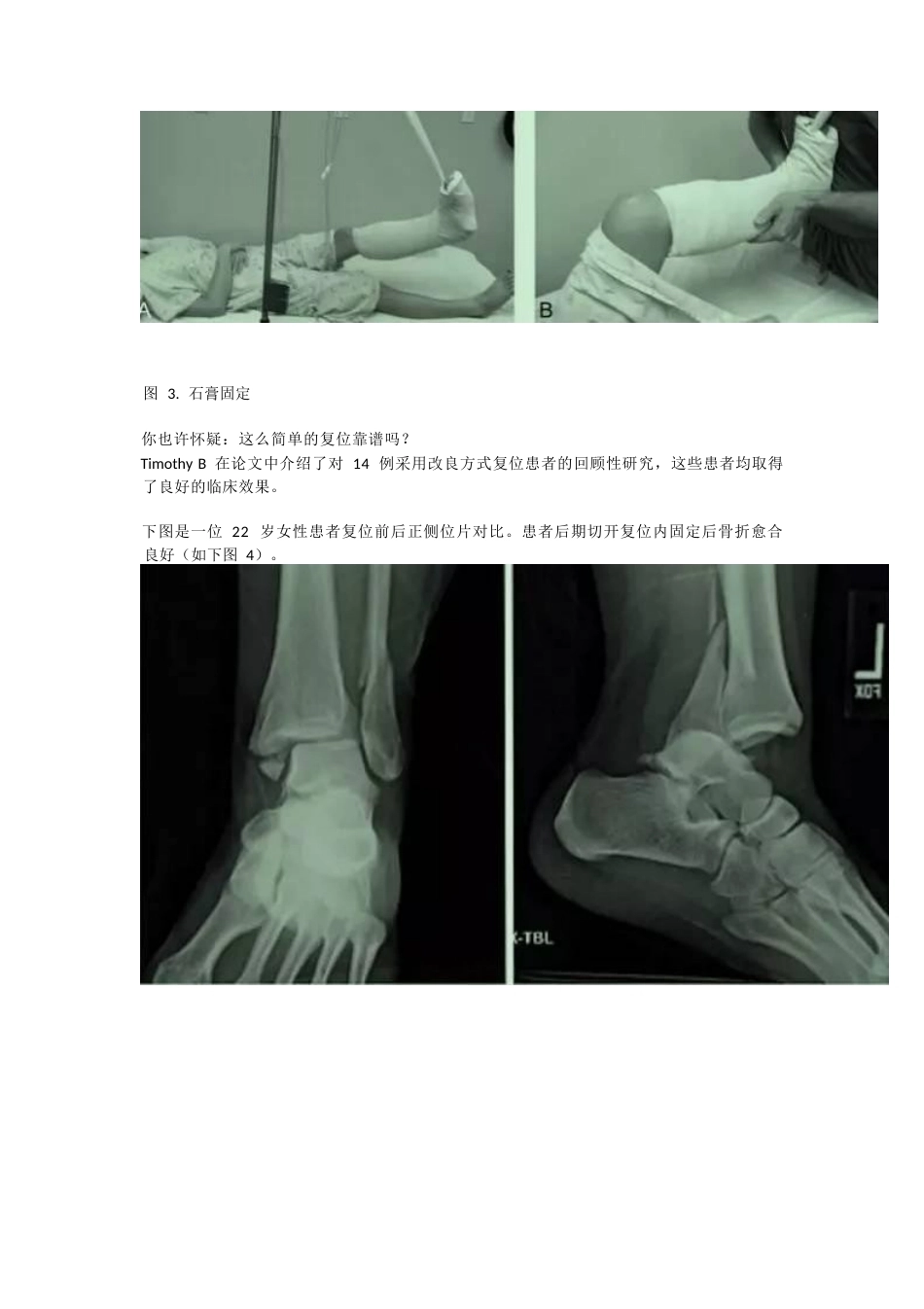 踝关节骨折闭合 复位技巧_第3页