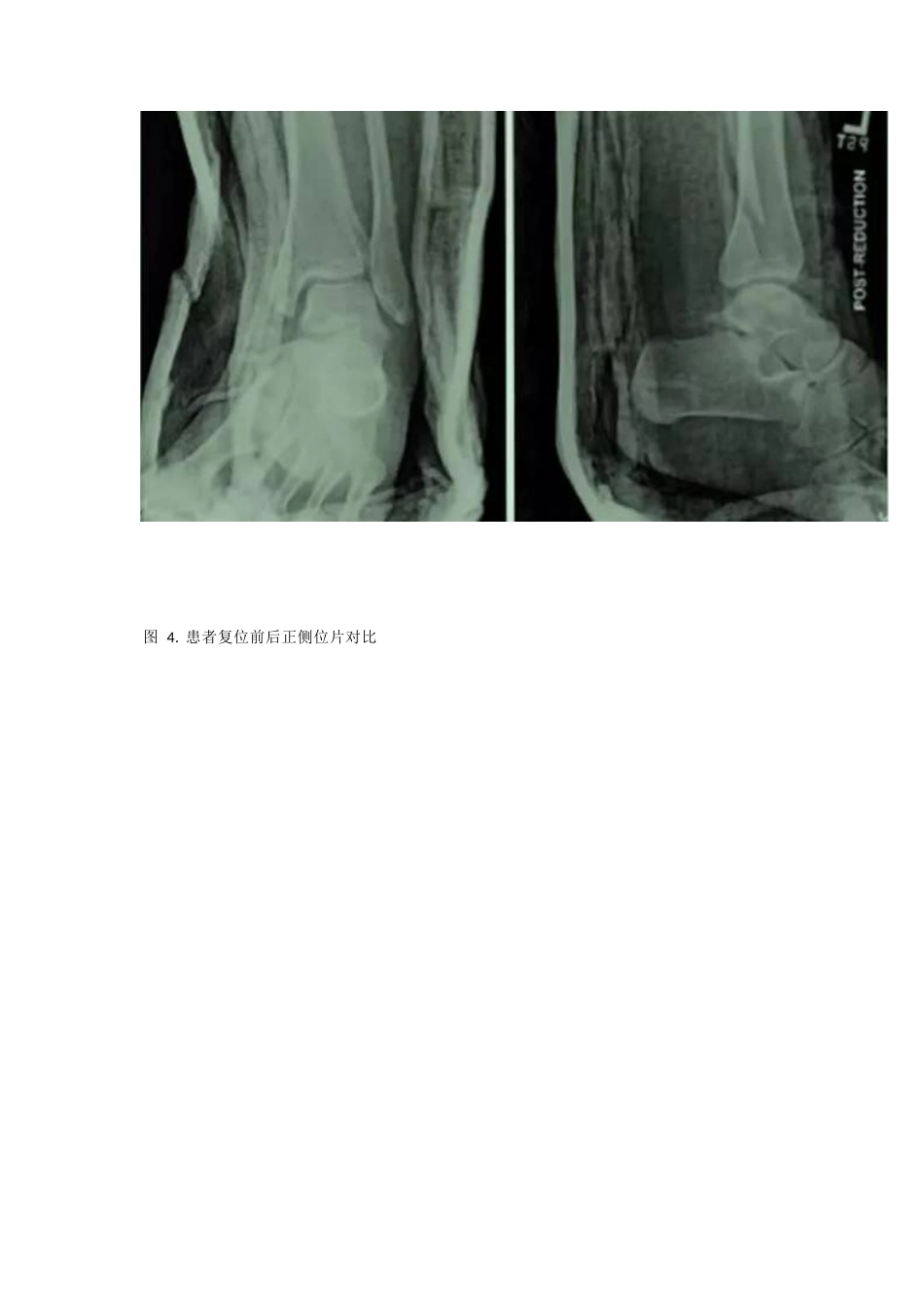 踝关节骨折闭合 复位技巧_第4页