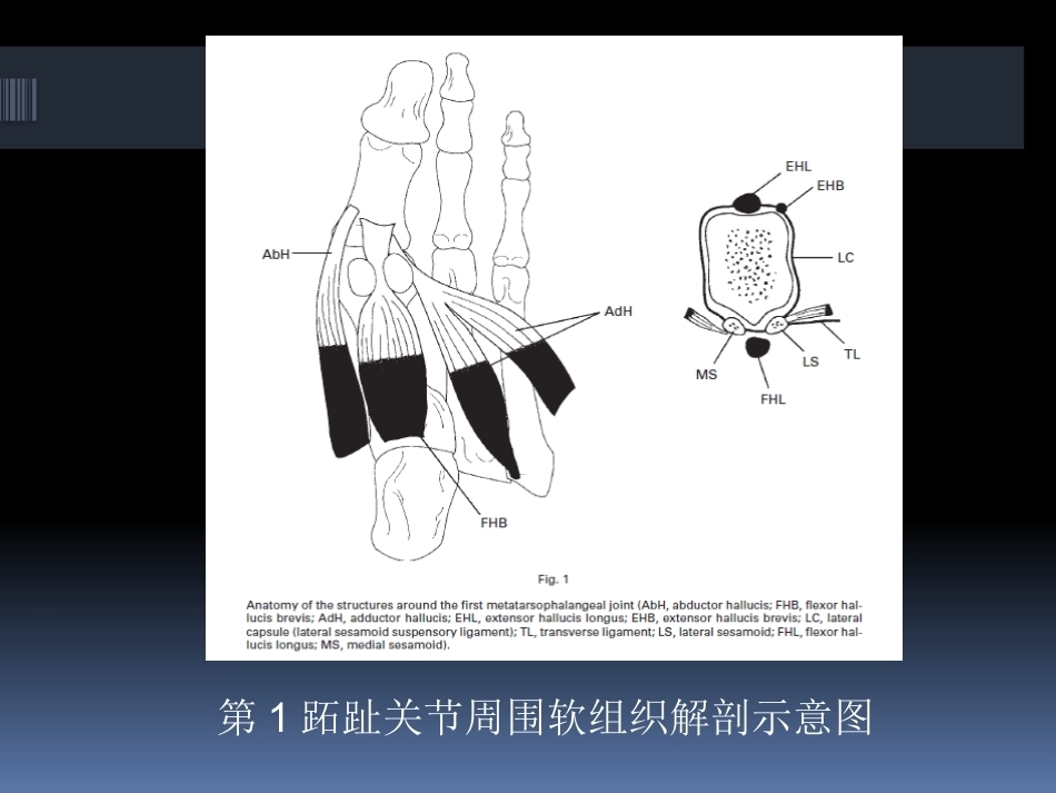 足拇 外翻的治疗_第10页