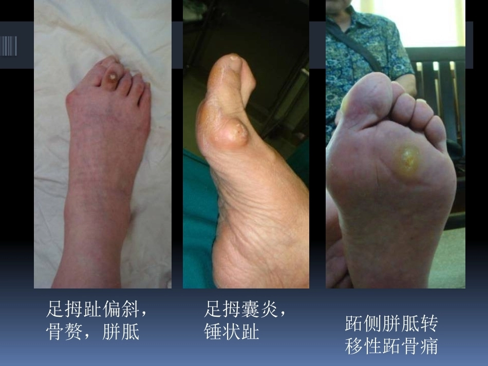 足拇 外翻的治疗_第12页