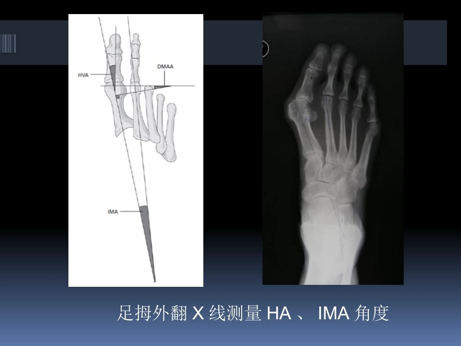 足拇 外翻的治疗_第14页