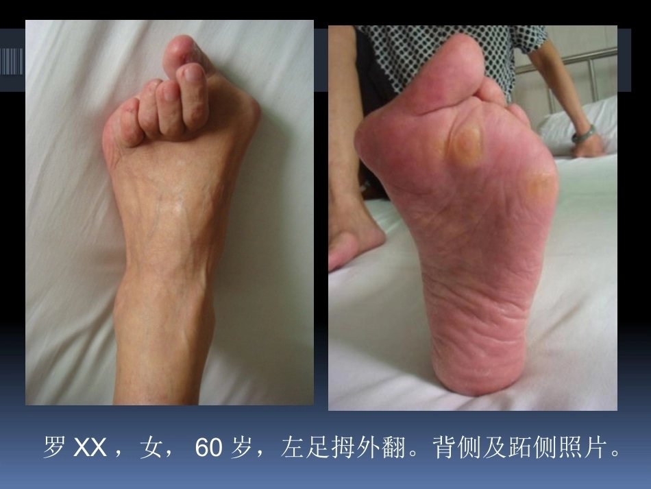 足拇 外翻的治疗_第5页