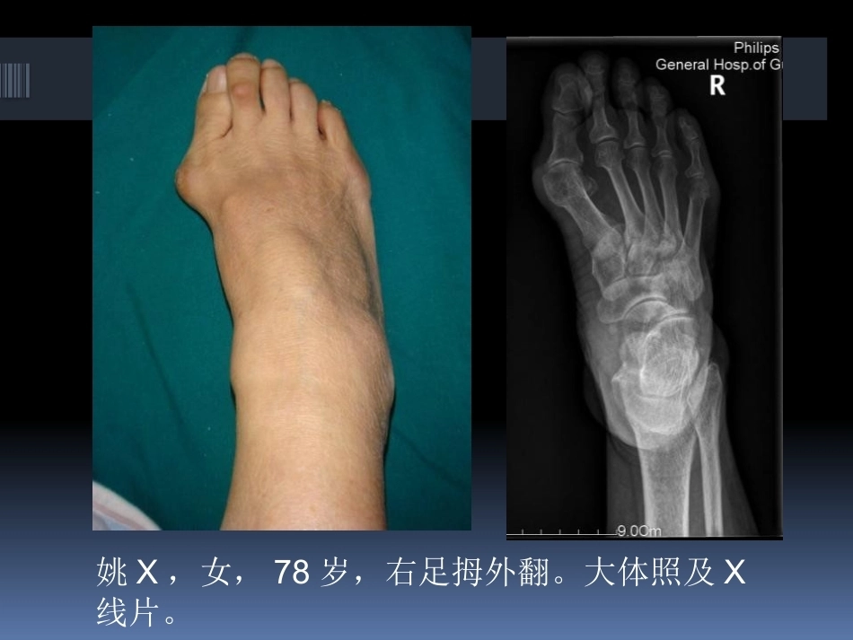 足拇 外翻的治疗_第6页