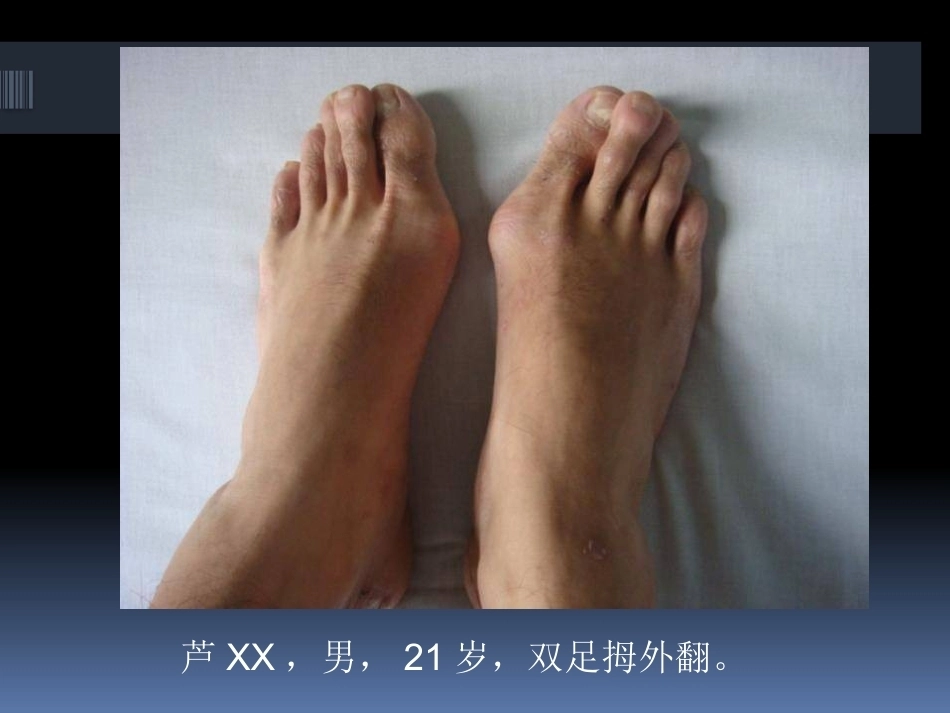 足拇 外翻的治疗_第7页
