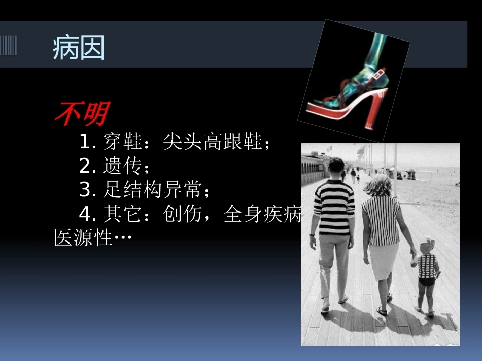 足拇 外翻的治疗_第8页