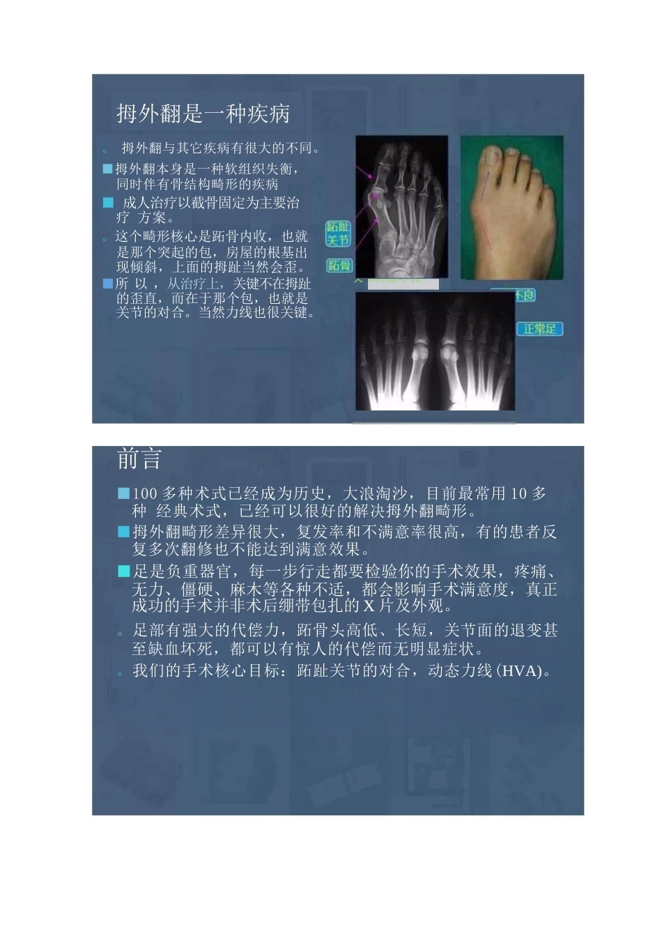 拇外翻的分型及术式的选择_第1页