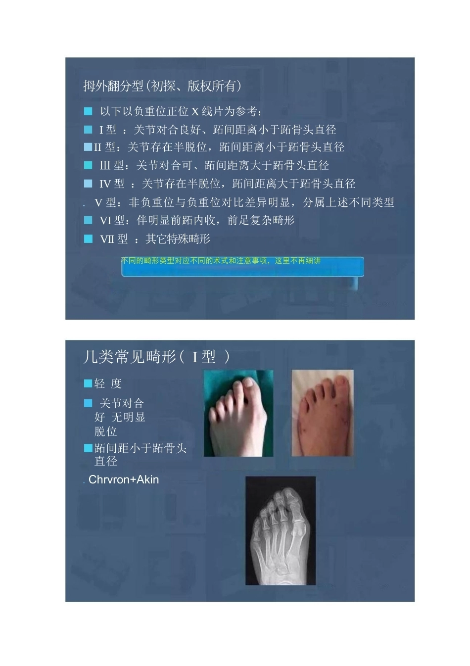 拇外翻的分型及术式的选择_第12页