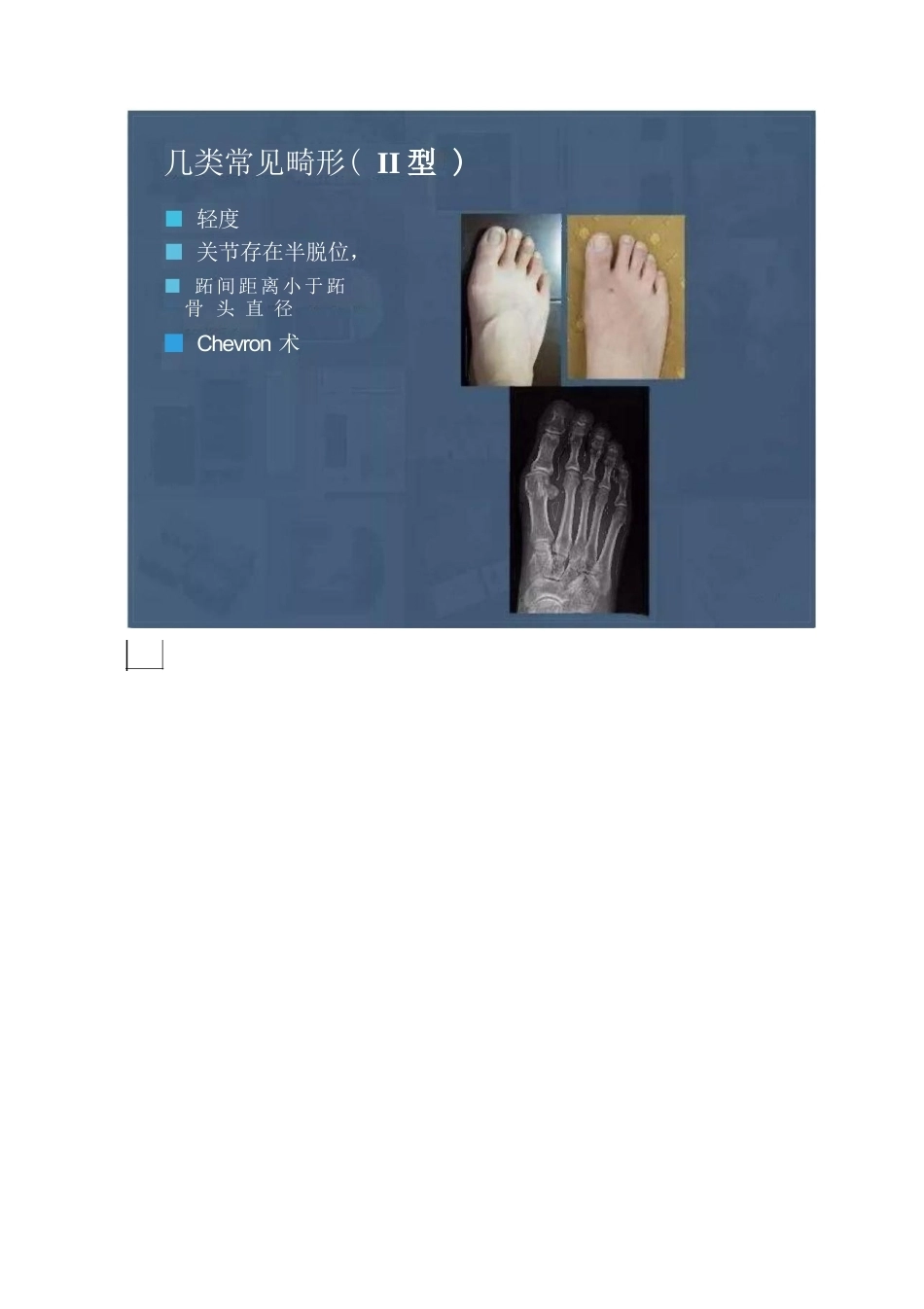 拇外翻的分型及术式的选择_第13页