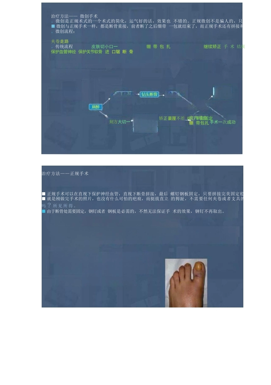 拇外翻的分型及术式的选择_第5页