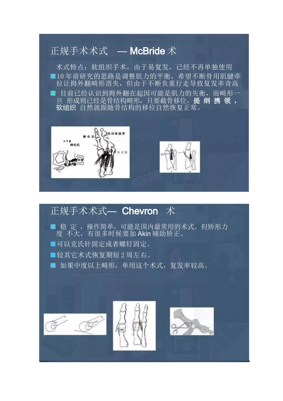 拇外翻的分型及术式的选择_第6页