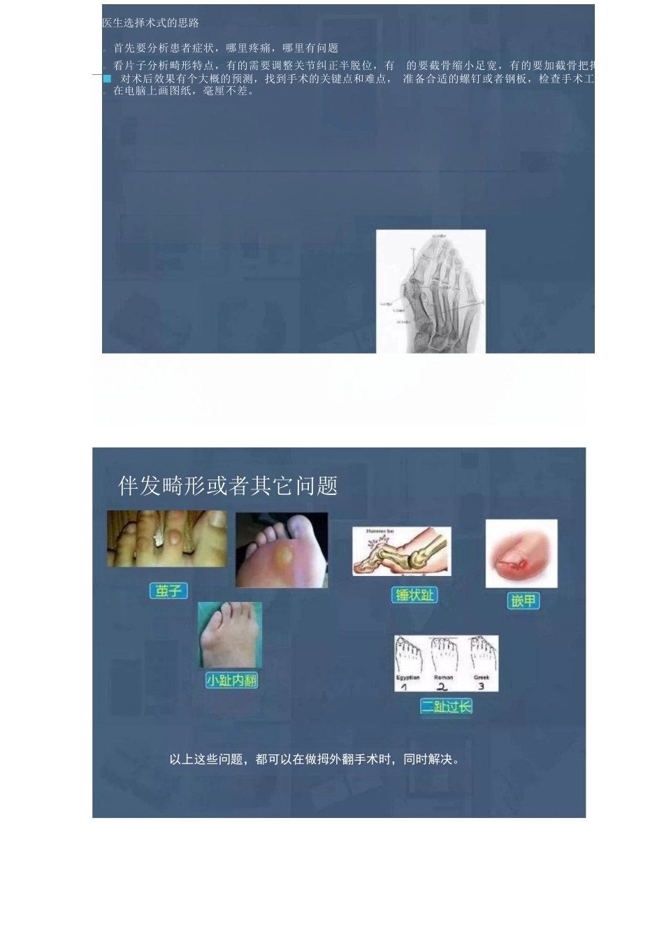 拇外翻的分型及术式的选择_第9页