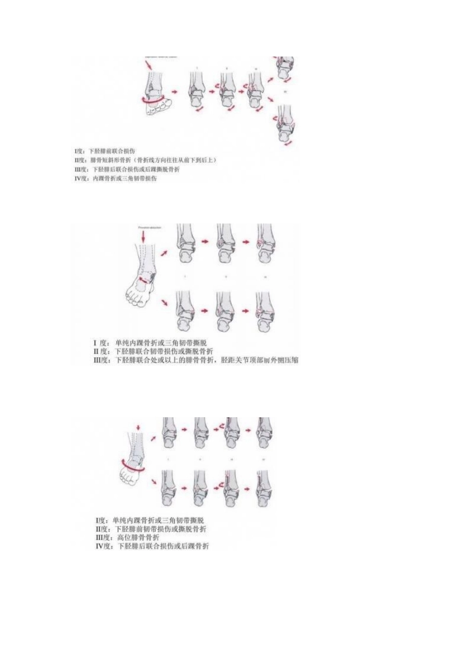 下肢骨折分型大全_第12页