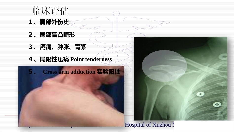 锁骨远端骨折伴肩锁 关节脱位的治疗_第12页
