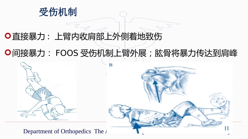 锁骨远端骨折伴肩锁 关节脱位的治疗_第3页