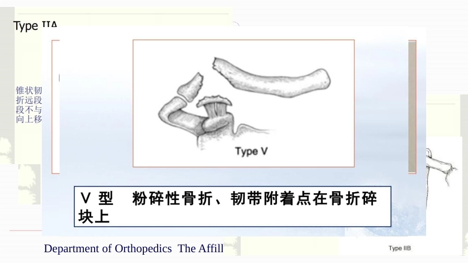 锁骨远端骨折伴肩锁 关节脱位的治疗_第8页