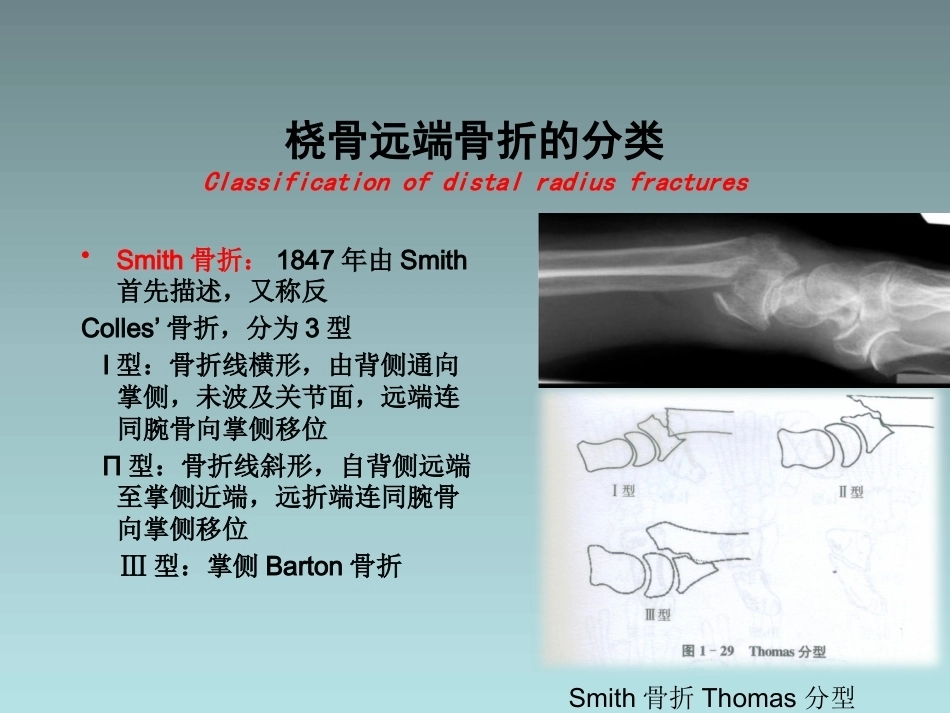 桡骨远端骨折的治疗_第13页
