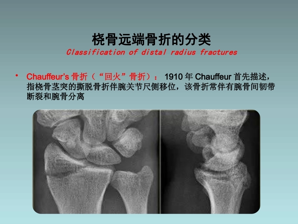 桡骨远端骨折的治疗_第15页