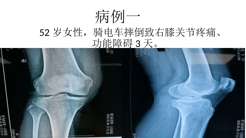 髁间脊撕脱骨折_第8页