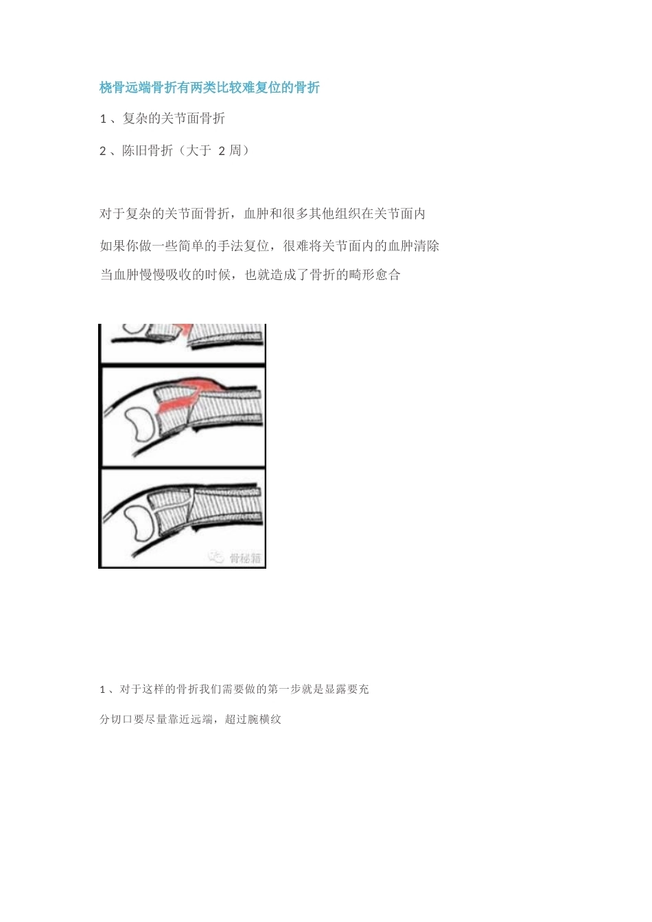 桡骨远端的复 位技巧_第1页