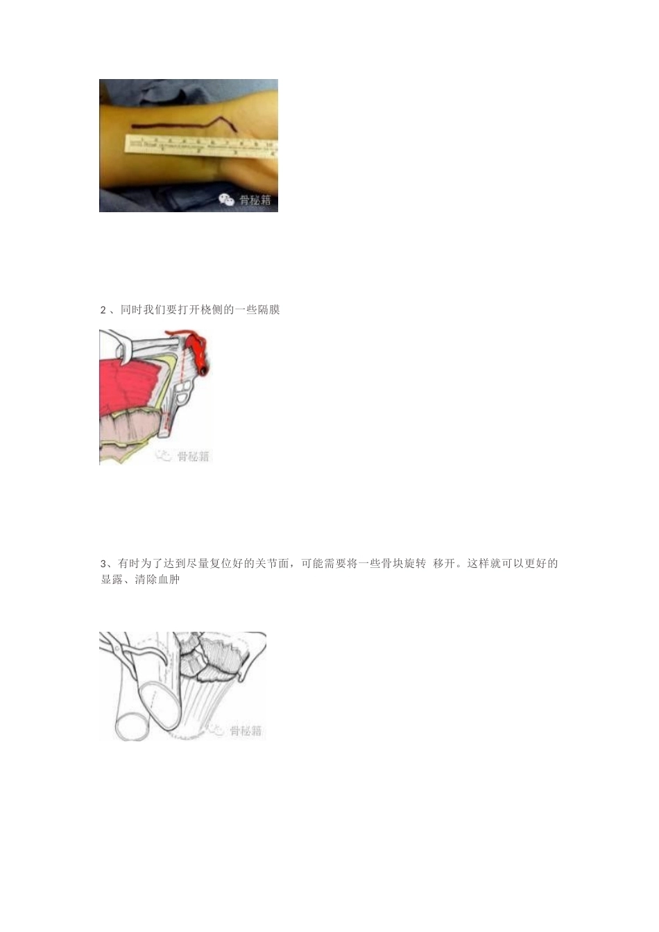 桡骨远端的复 位技巧_第2页