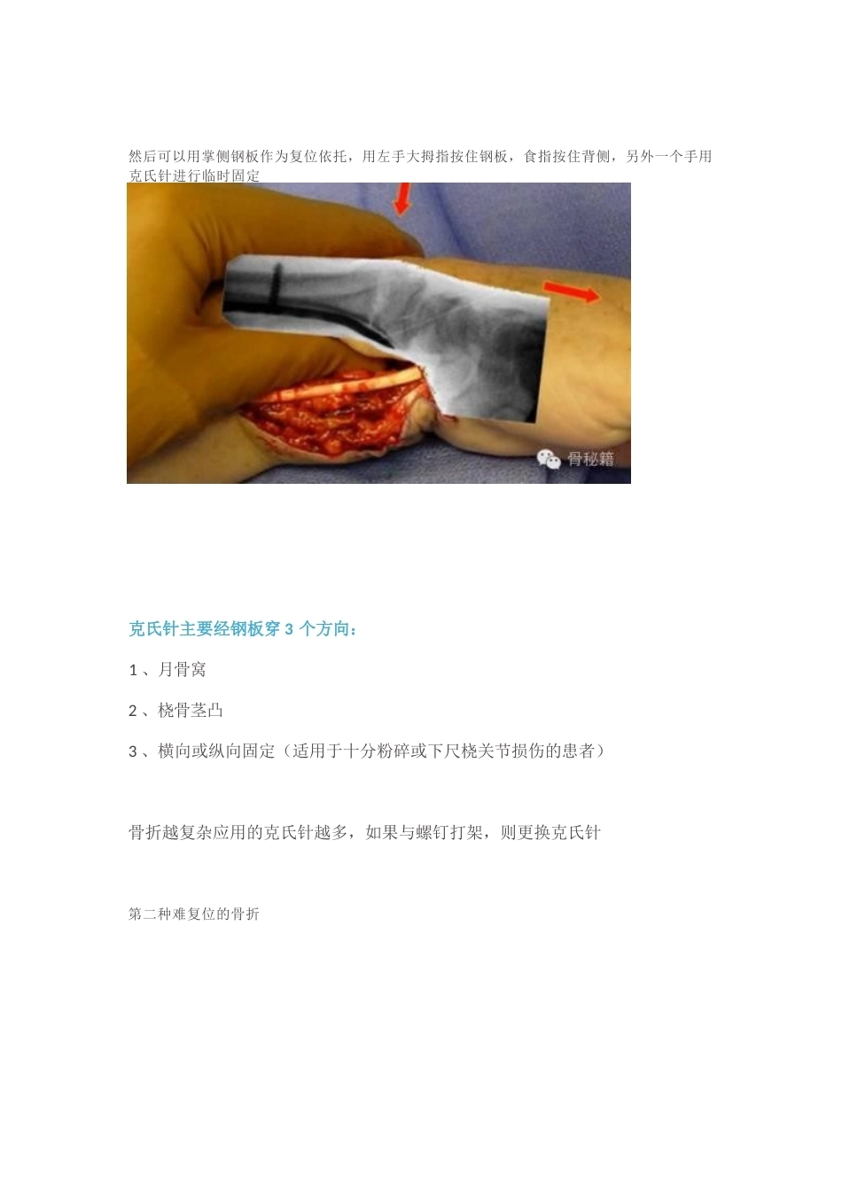 桡骨远端的复 位技巧_第4页