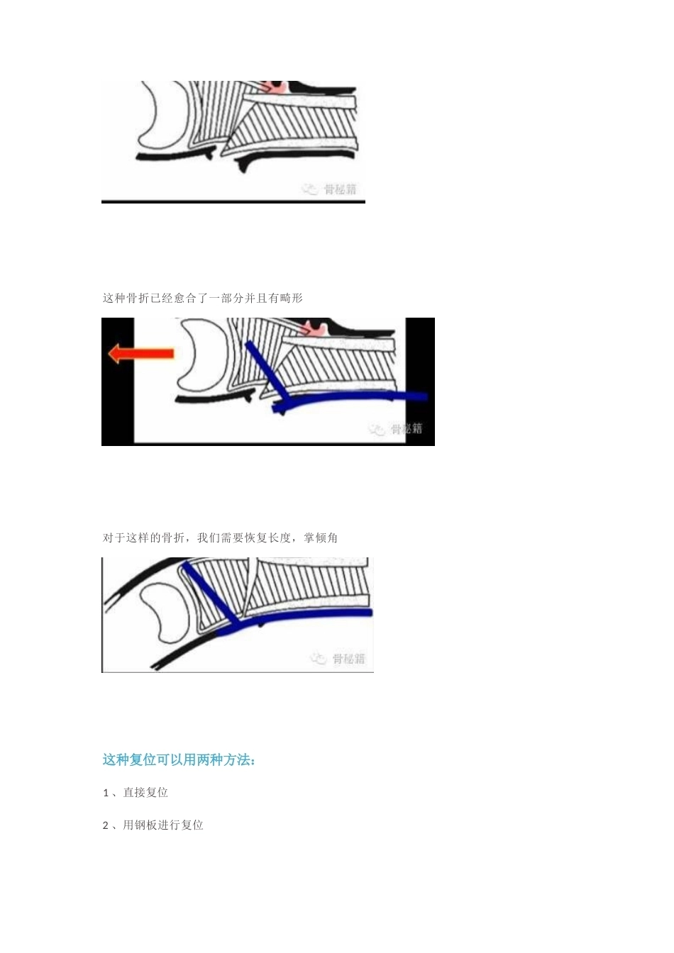 桡骨远端的复 位技巧_第5页