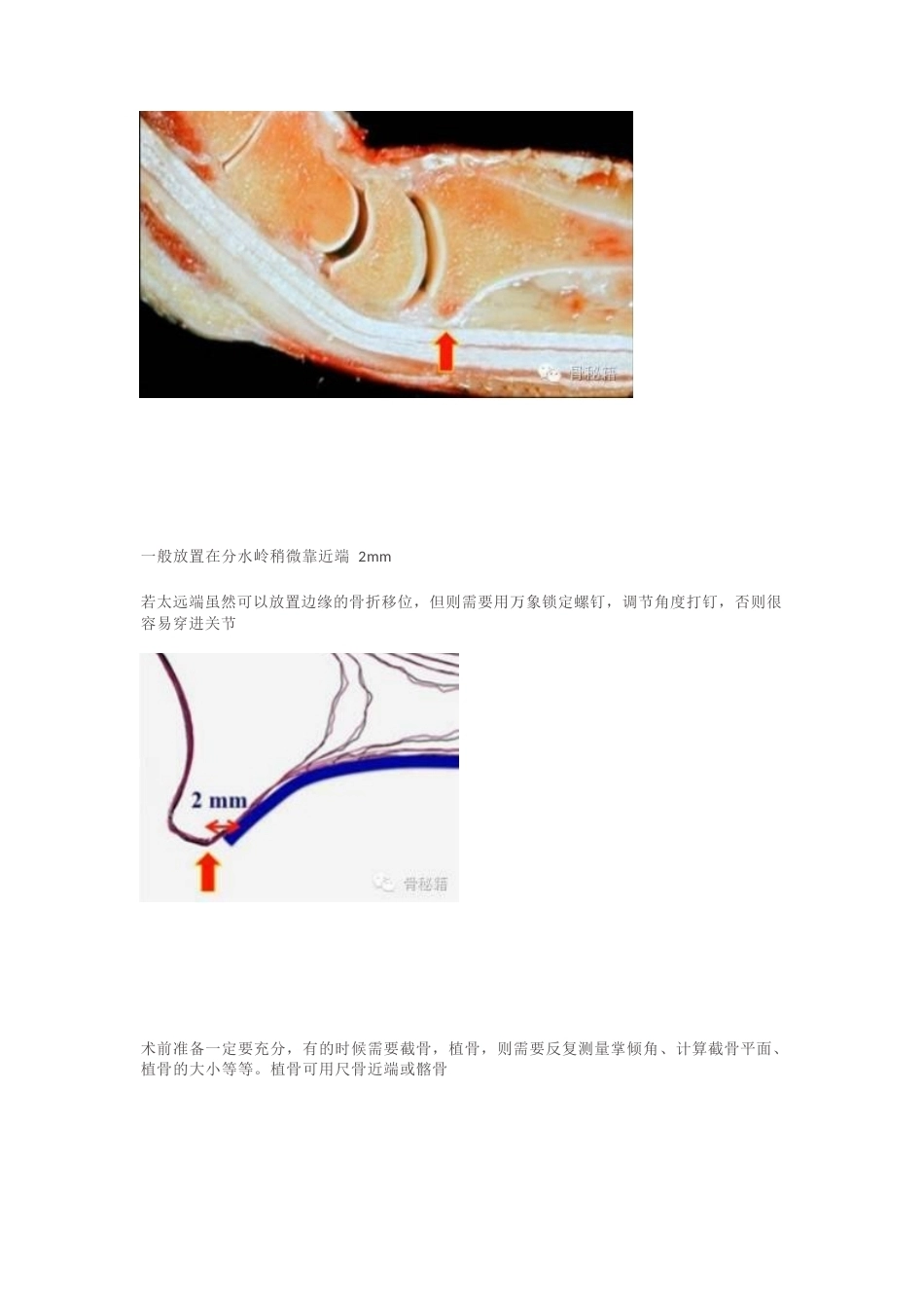桡骨远端的复 位技巧_第8页