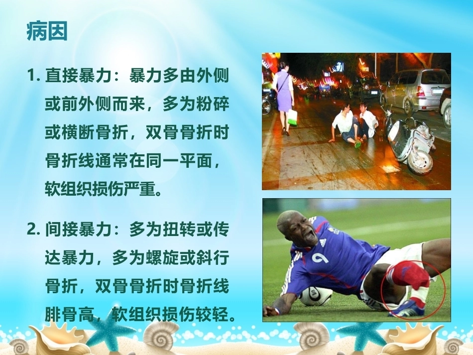 胫腓骨骨折分型_第10页