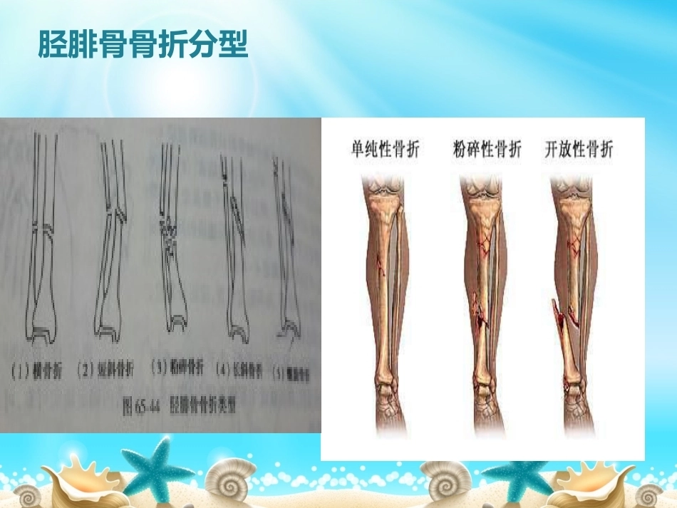 胫腓骨骨折分型_第11页