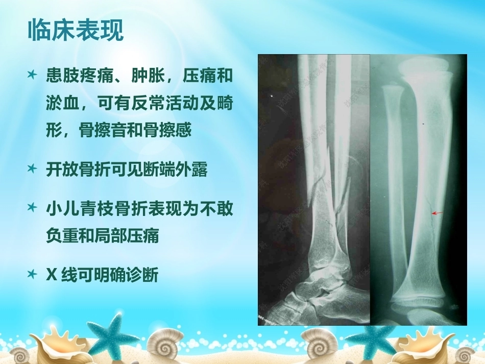 胫腓骨骨折分型_第12页