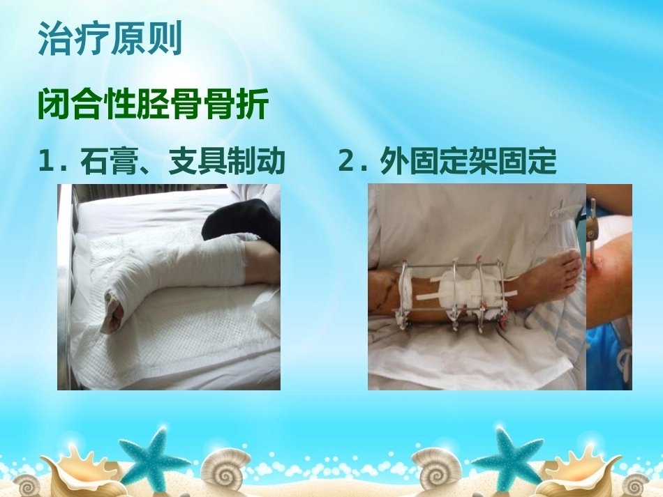 胫腓骨骨折分型_第15页