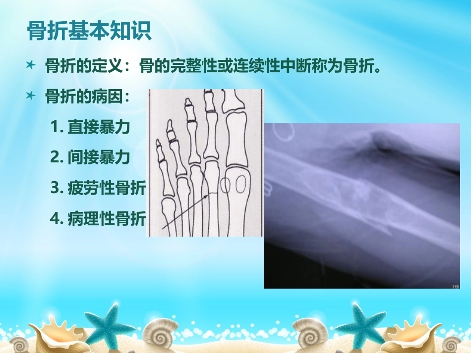 胫腓骨骨折分型_第2页