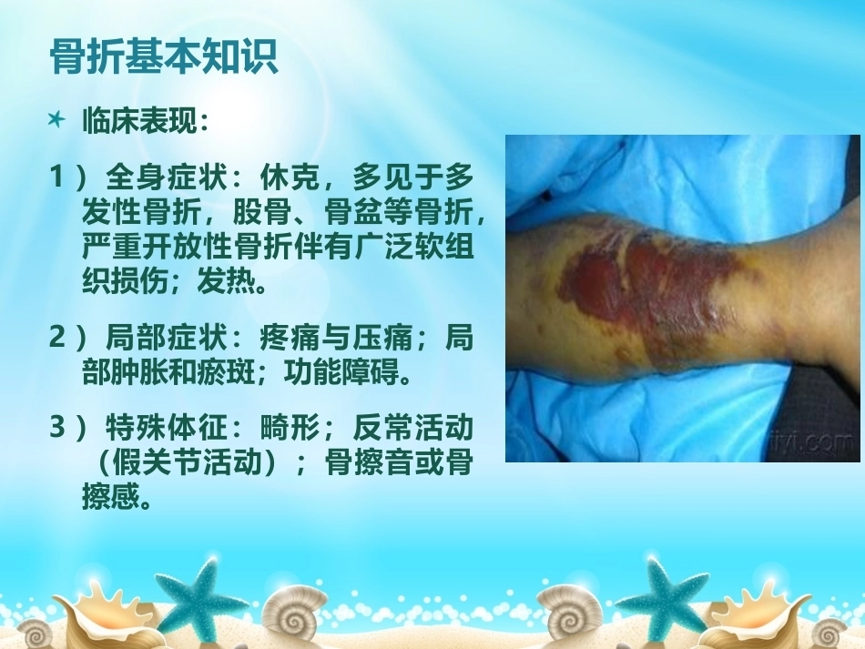 胫腓骨骨折分型_第4页