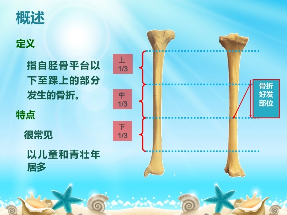 胫腓骨骨折分型_第7页