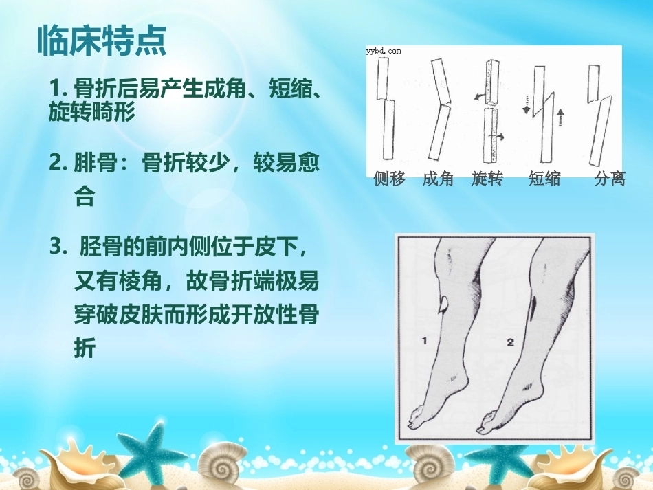 胫腓骨骨折分型_第8页