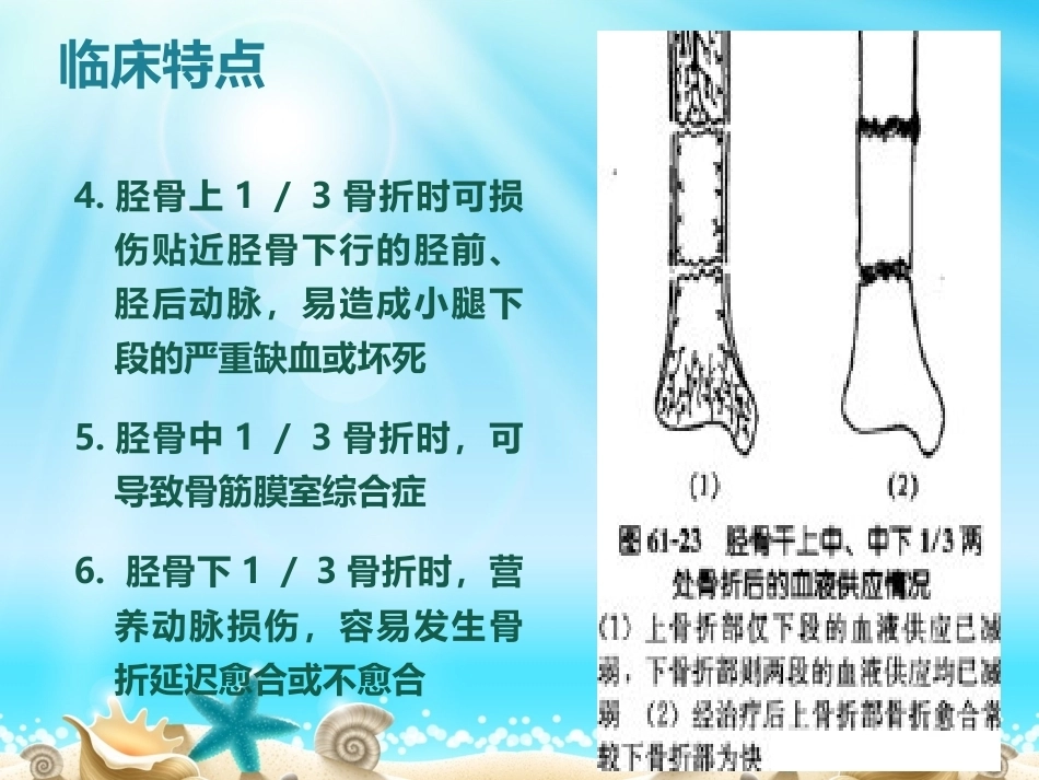 胫腓骨骨折分型_第9页